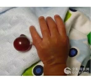 儿童小指尺侧肉赘缝扎不彻底会引发感染 3个月大手术切除