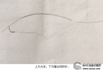 徐州仁慈医院采用最细显微线接活了头发丝一样细血管神经