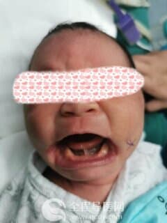 男婴患先天性面裂畸形 徐州市儿童医院儿外科妙手“重塑天使面孔”