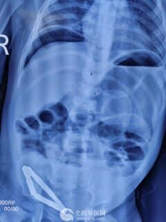 幼童误吞大量磁力珠，徐州儿童医院曹慧：误食磁力珠后果严重，会引起肠穿孔