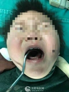 11个月宝宝玩晾衣架插入口腔，徐州市儿童医院手术成功取出