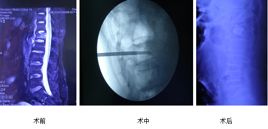 骨質疏鬆性椎體骨折微創與開放治療84例分析(圖5)