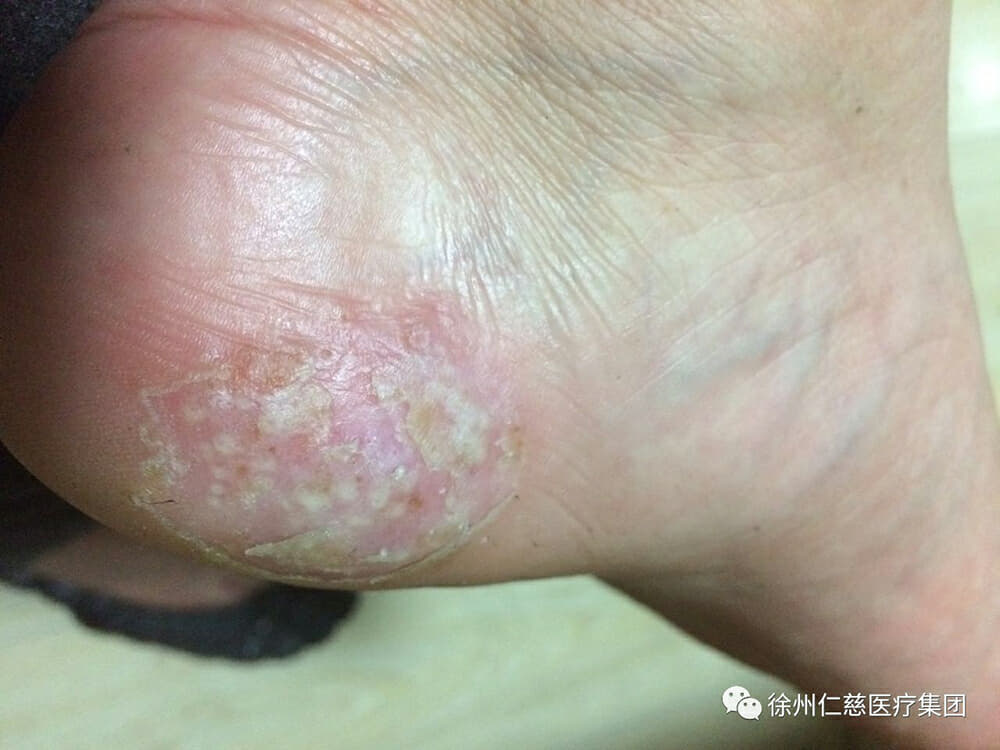 仁慈医院王娜:警惕脚上长水疱 有可能是皮肤病