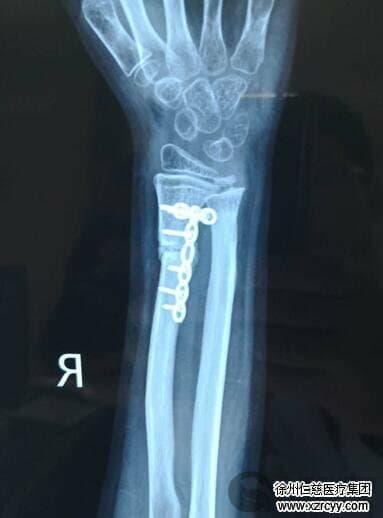 男童手腕骨折治疗一波三折 徐州仁慈医院复位 植骨治疗儿童骨折
