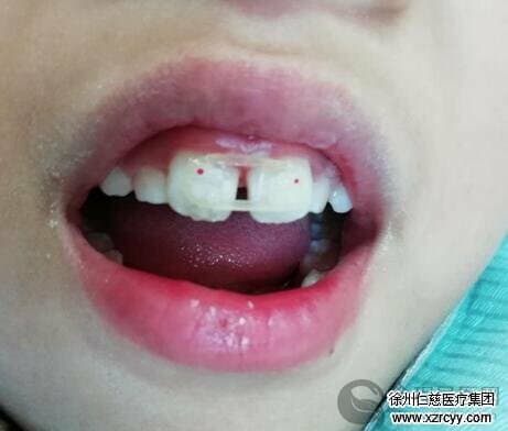 学龄儿童牙缝越来越大 徐州仁慈医院口腔科:多种因素可能导致