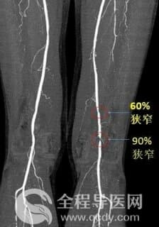 “米粒”切口，1天下床、3天出院 矿总院血管腔内斑块旋切术还原血管