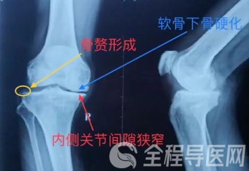 骨关节炎的发病因素有哪些?徐州康复医院为你科普